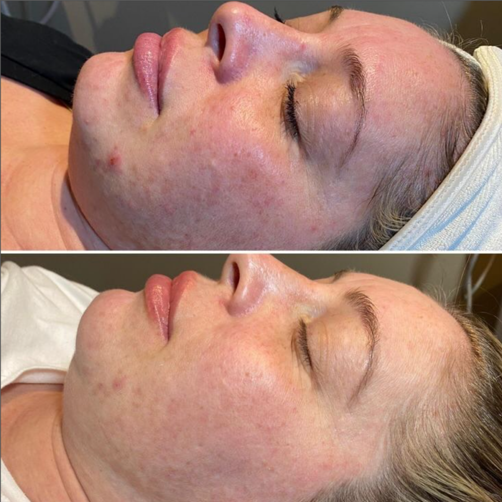 What Are The Results of Microneedling