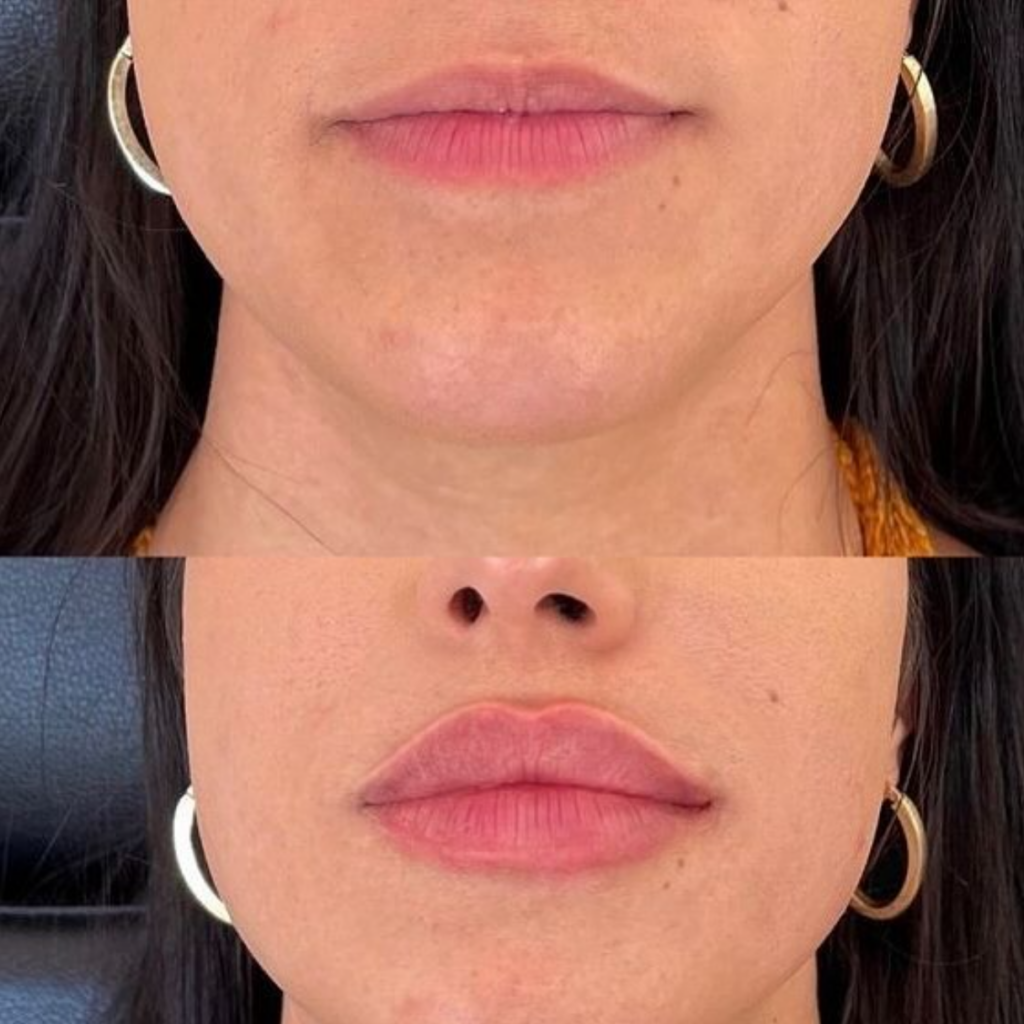 Can You See the Results of Microneedling