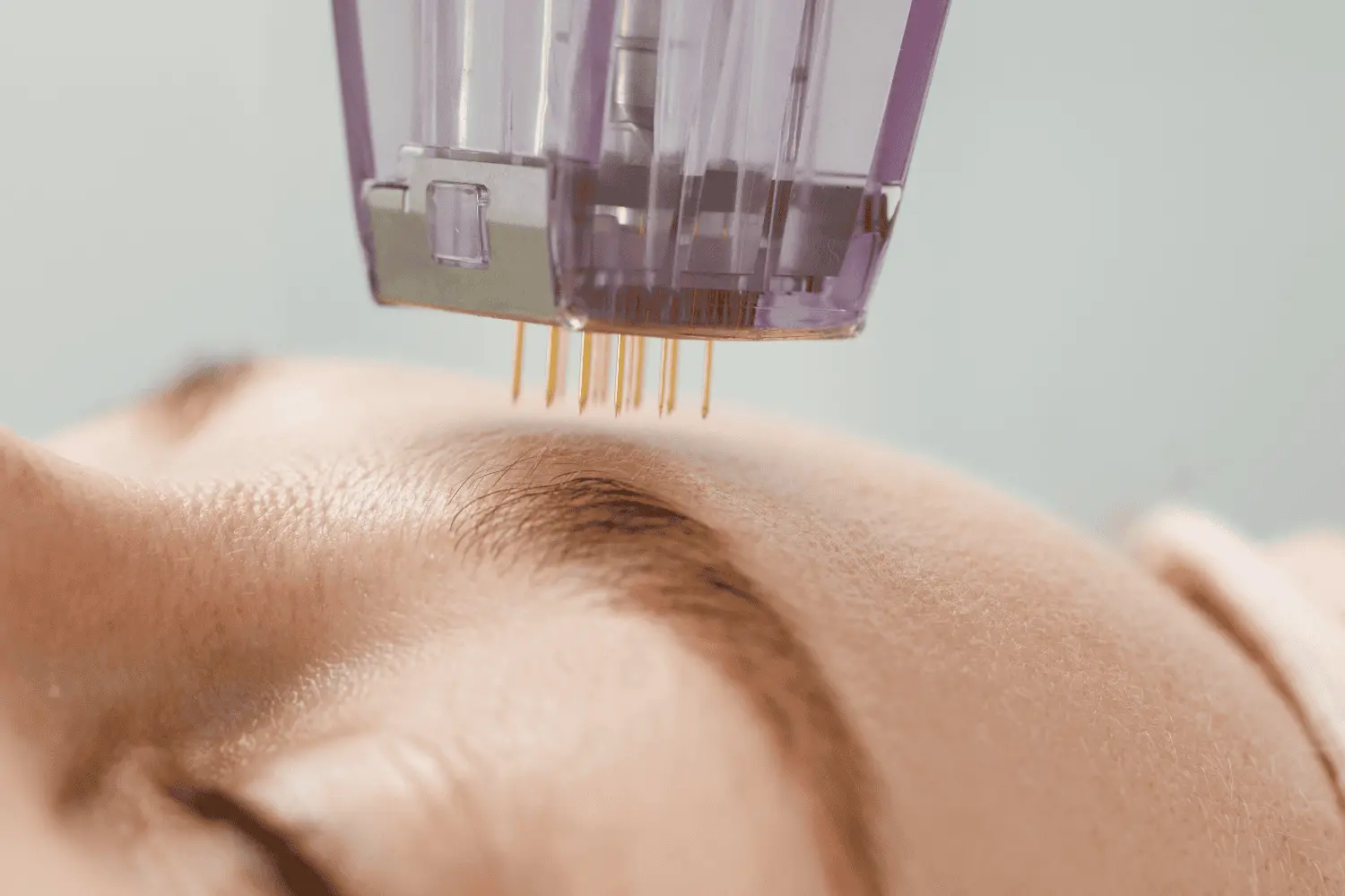 The Science Behind RF Microneedling and Why It Works