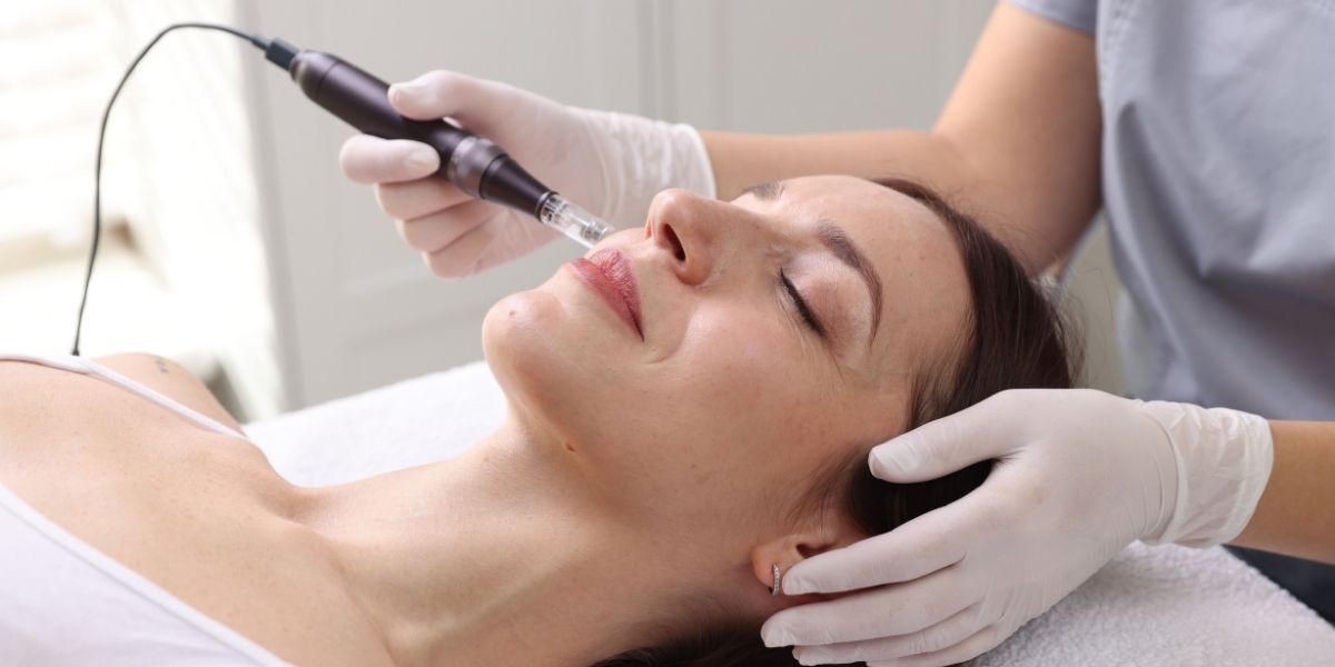 RF microneedling treatment in Falls Church VA at KenshoDerm for skin rejuvenation