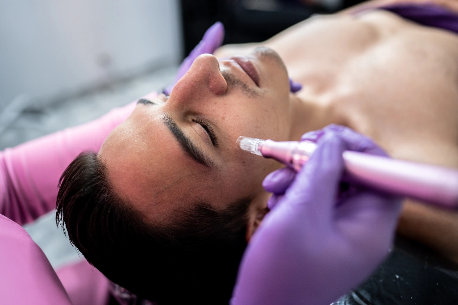 Microneedling With PRP For Minimal-Downtime Skin Rejuvenation