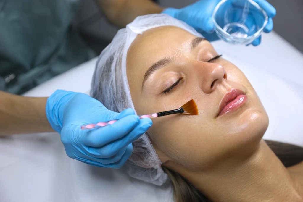 Chemical Peels For Dark Spots And Uneven Skin Tone