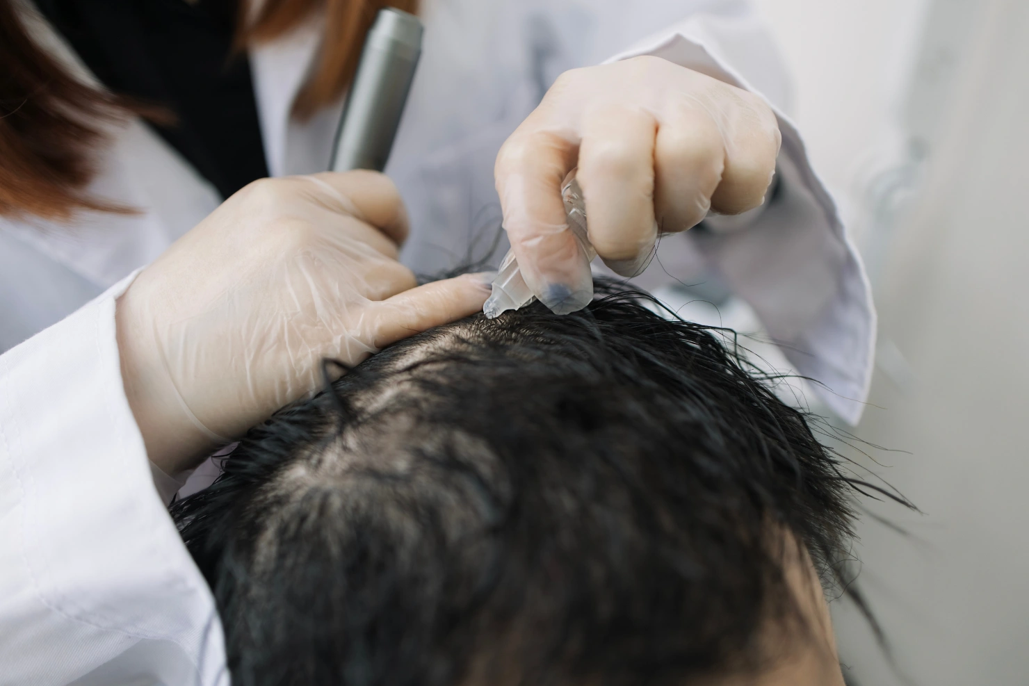 Advanced Hair Regrowth Options Before Considering A Hair Transplant
